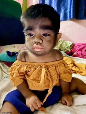 生出“狼人”！两岁儿长满黑毛 妈妈自责：怀孕吃猫诅咒