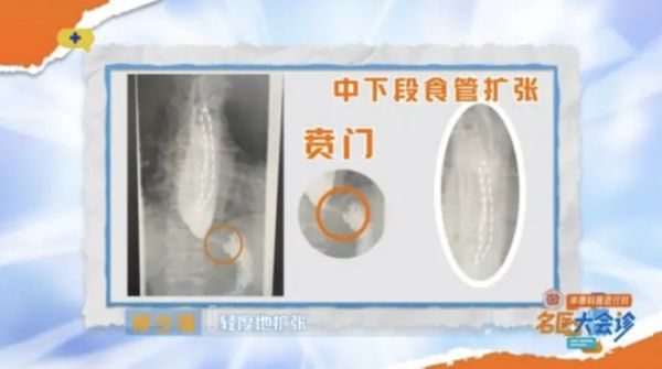 食物全卡在食道内 男子一次只能吞一粒米