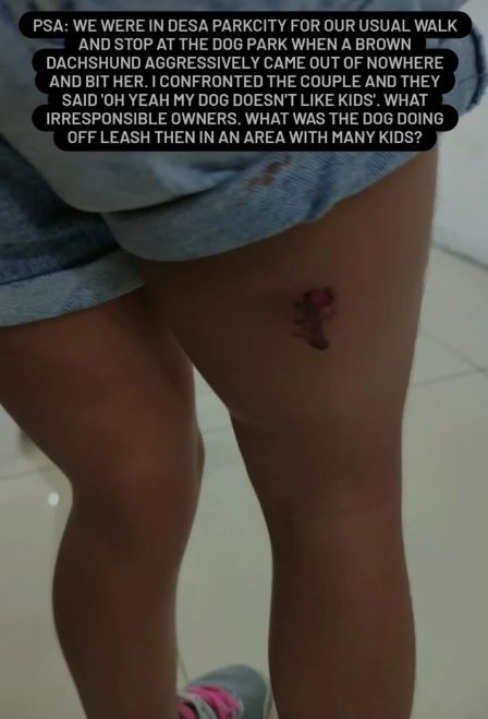 4岁女童被咬伤狗主没道歉!答“我的狗不喜欢小孩”便离开