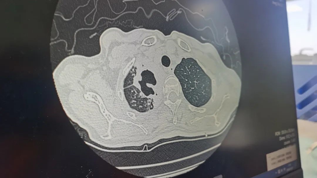 亚太国家测试应对耐药性肺结核新疗法 或有助减轻病人负担