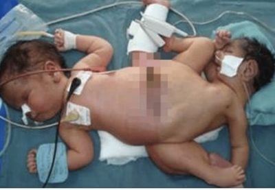 印尼“蜘蛛连体婴” 下身“融合”共用三腿一阴茎