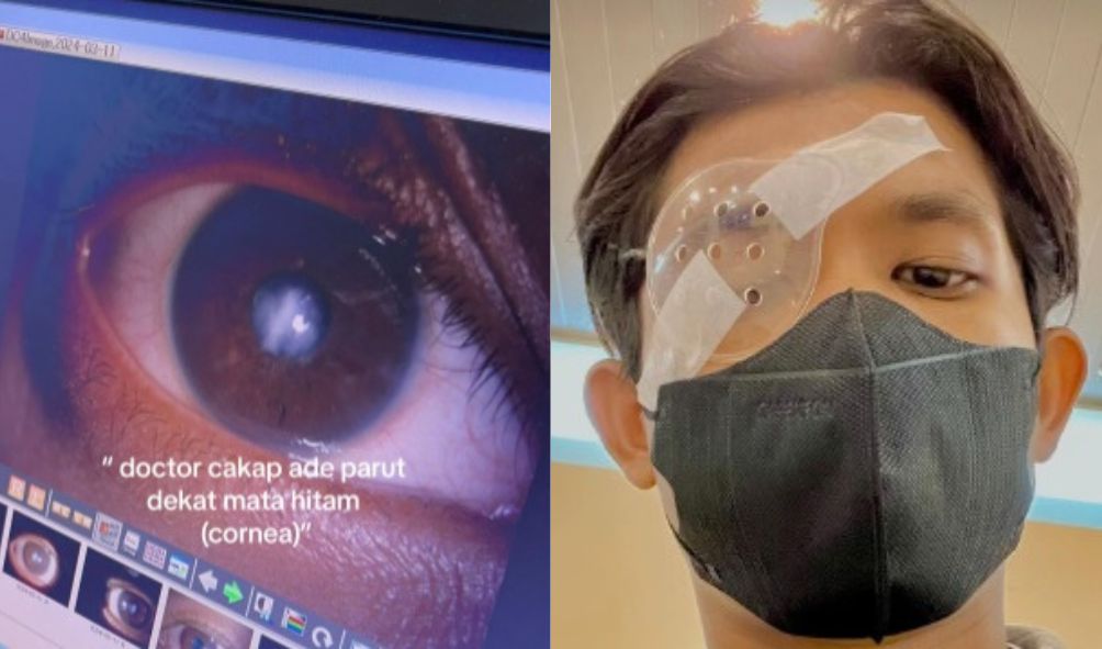 常揉眼睛致眼角膜受伤须动手术  21岁青年劝大众改掉坏习惯