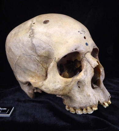 拼盘/古埃及医学多先进?4000年前头骨找到惊人“治癌”痕迹