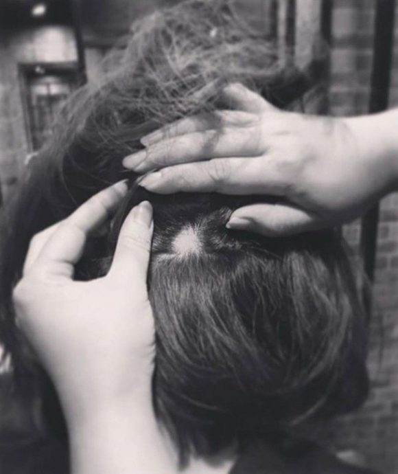 颈上硬块“悬而未决”高海宁再现鬼剃头