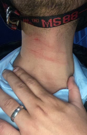 骑行遭不明线割伤下巴 事主:SUKE已联系我!