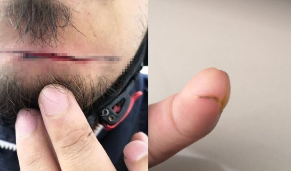 骑行遭不明线割伤下巴 事主:SUKE已联系我!