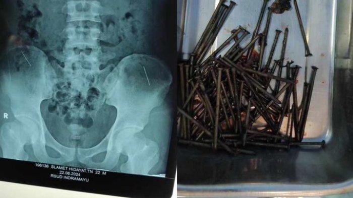 供星洲网:异食癖男子好尖锐物体 竟生吞70根钉子