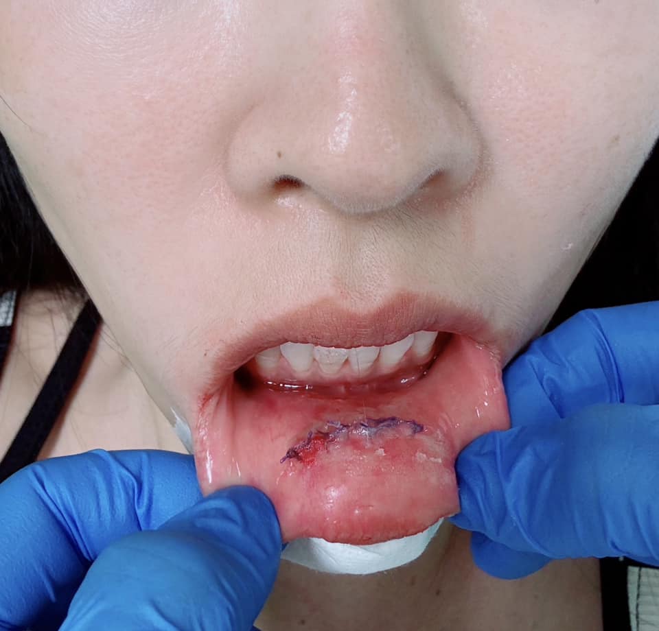 小娴门牙咬裂嘴巴缝针　讲话漏风停工