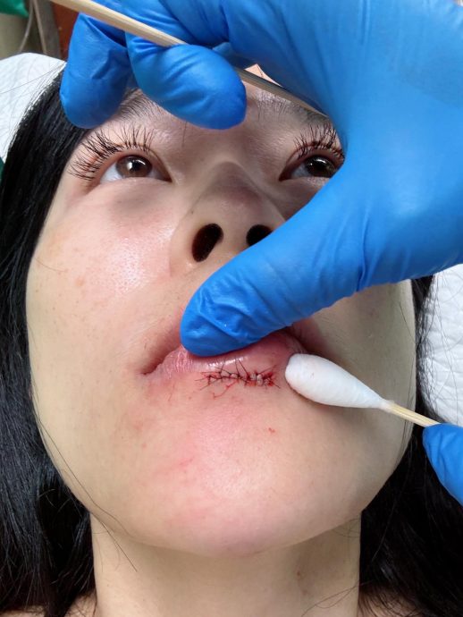 小娴门牙咬裂嘴巴缝针　讲话漏风停工