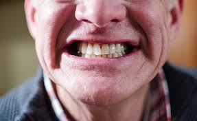 日本研究:臼齿缺失的老年人患失智症风险更高