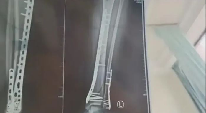 穿7cm厚“洞洞鞋”崴脚 女子摔成粉碎性骨折