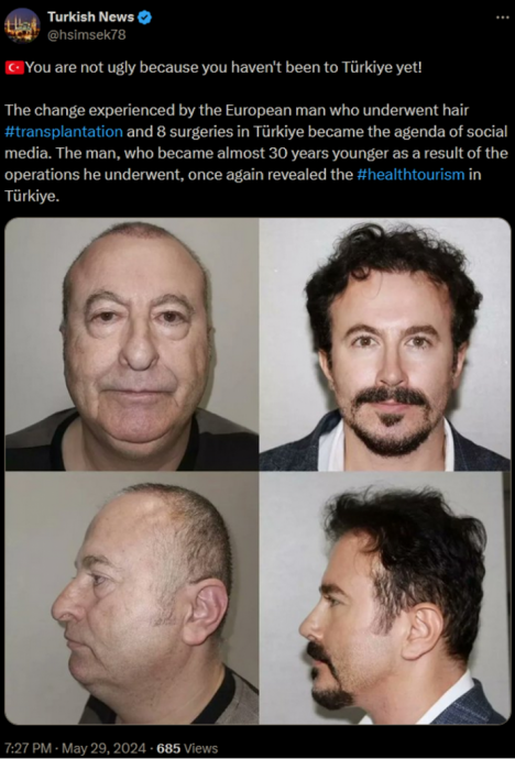 (求真)在土耳其接受整形手术能够让你看起来年轻30岁?