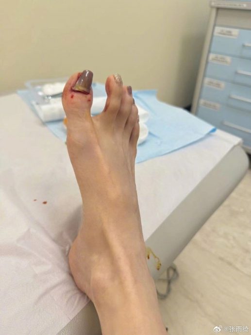 张雨绮穿露趾鞋摔伤 整块脚甲盖翻起画面惊悚