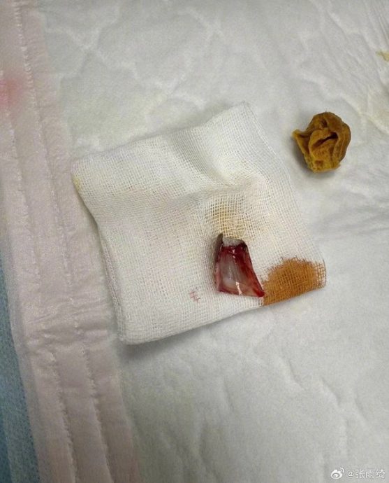 张雨绮穿露趾鞋摔伤 整块脚甲盖翻起画面惊悚