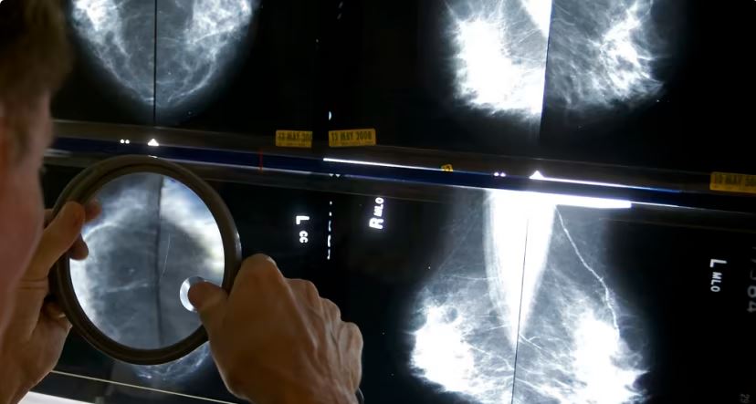 澳洲科学家开发出新AI工具 可改善患者对癌症治疗的反应