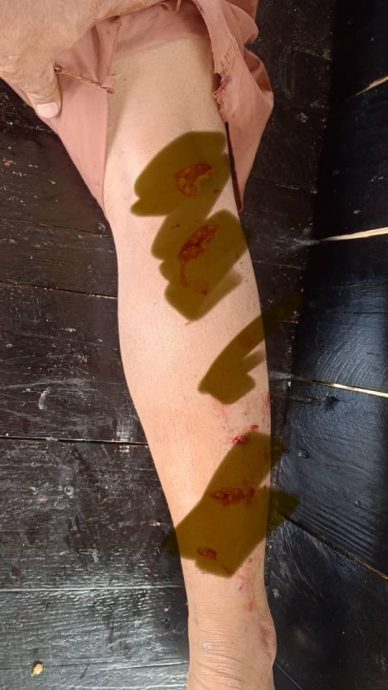 13岁男孩被狗咬伤致截肢 可恶狗主不认是主人!