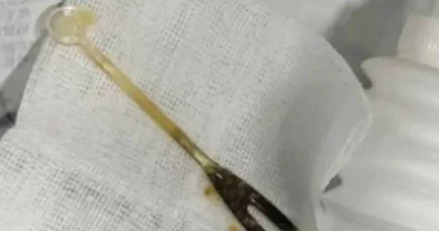 供星洲网:男子腹痛三个月以为长肿瘤 开刀取出竟是叉子