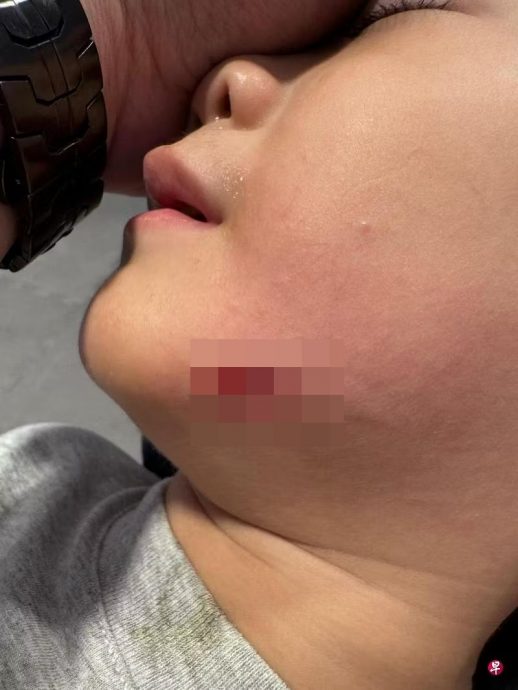 *已签发*柔:狮城二三事:在火锅店游乐房跌倒 狮城4岁童下巴割伤缝针