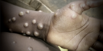 Mpox vs Covid-19: Key differences you need to know