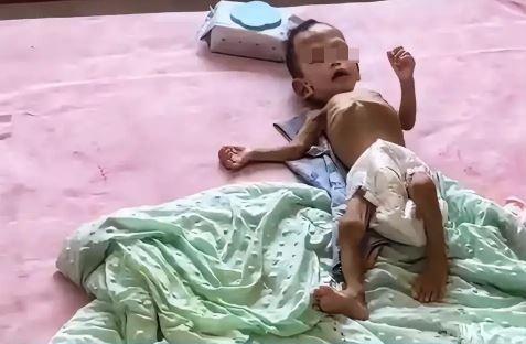 1岁娃饿至皮包骨仅约2.5公斤 父亲:没能力养