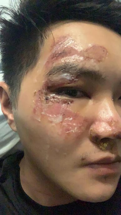 *已签发*柔:狮城二三事:疑酒后与人起口角 狮城男子遭打滚下梯