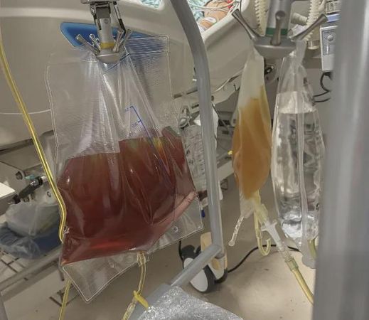 爱你变成害你 女子摘野菇烹煮 丈夫吃下中毒濒死