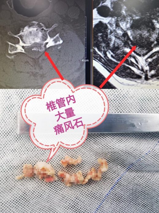 爱喝「骨头汤」竟险致瘫痪? 广东大叔颈椎长10多块痛风石