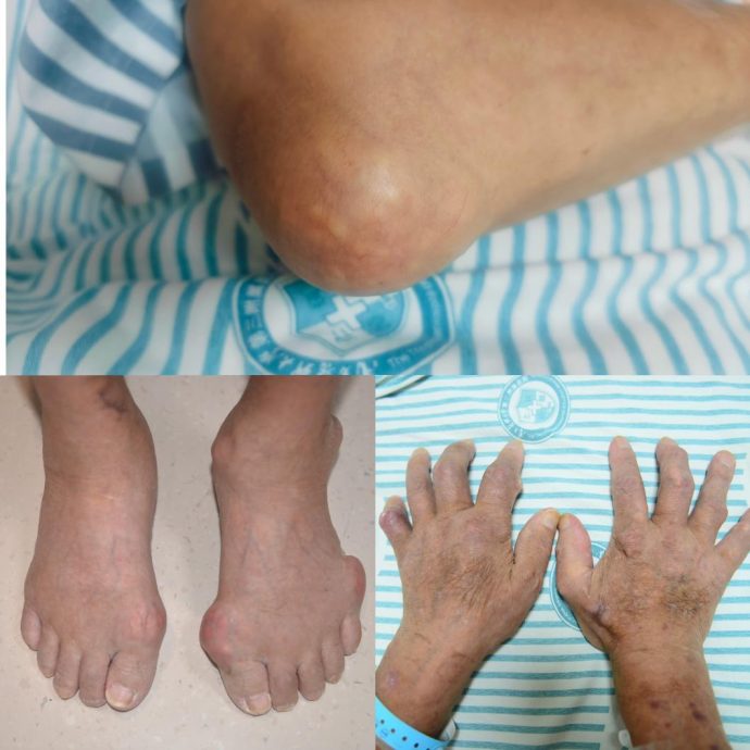 爱喝「骨头汤」竟险致瘫痪? 广东大叔颈椎长10多块痛风石