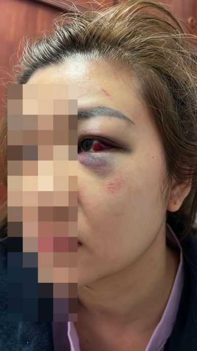 供网//遭恐怖情人施暴致伤|指男方先报案指控她动手·女郎：我才是受害者