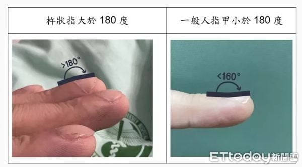 十指变杵状指确诊肺结核 医:一旦发现速就医