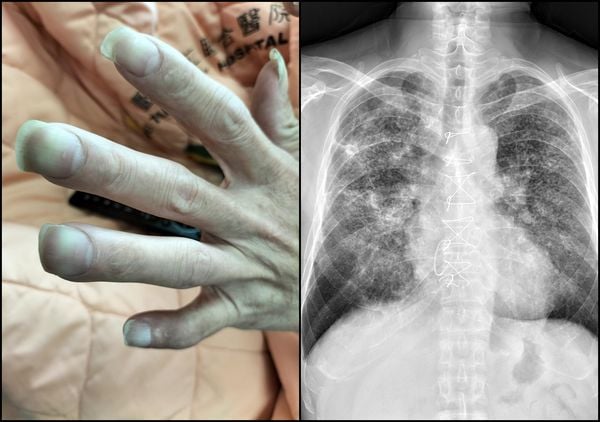 十指变杵状指确诊肺结核 医:一旦发现速就医