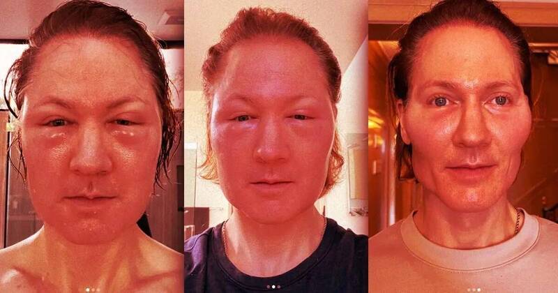 逆龄实验酿祸!科技富豪注射他人脂肪 脸部严重肿胀险失明