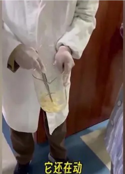 女子体内藏绦虫一年 排出10公尺寄生虫