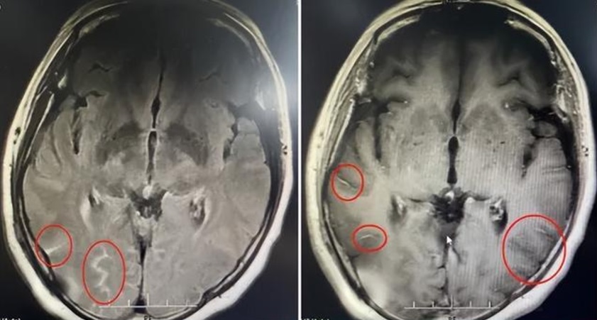 妇女头痛欲裂感染脑膜炎 竟是在巴刹接触了这种东西!