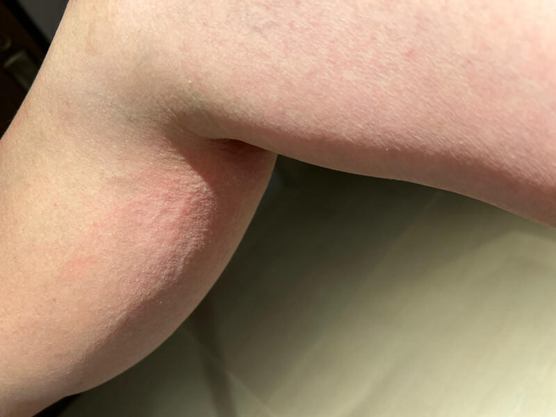 *已签发*柔:狮城二三事:玻璃碎裂床单不干净起红疹 父女指酒店职员态度差索赔遭拒