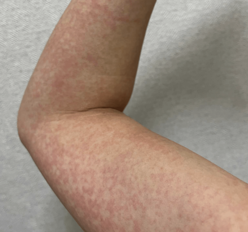 拚盘,未签)东京等地「苹果病」个案创新高 小童易中招 孕妇恐流产