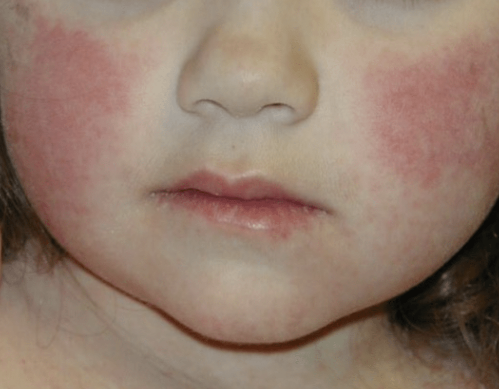 拚盘,未签)东京等地「苹果病」个案创新高 小童易中招 孕妇恐流产