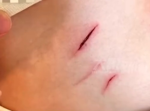 (视频)女子湖边打卡遭高速无人机撞脸险破相 “现听到无人机声音就怕”