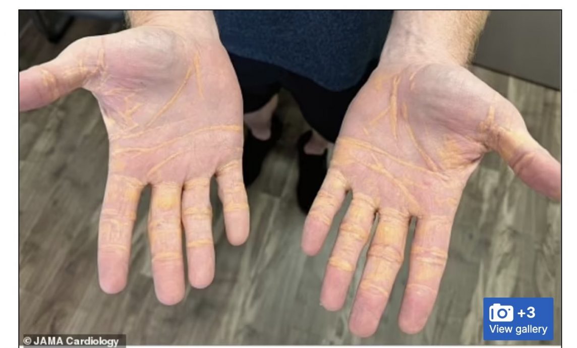 实行极端肉食主义8个月 男子手脚渗诡异黄色分泌物