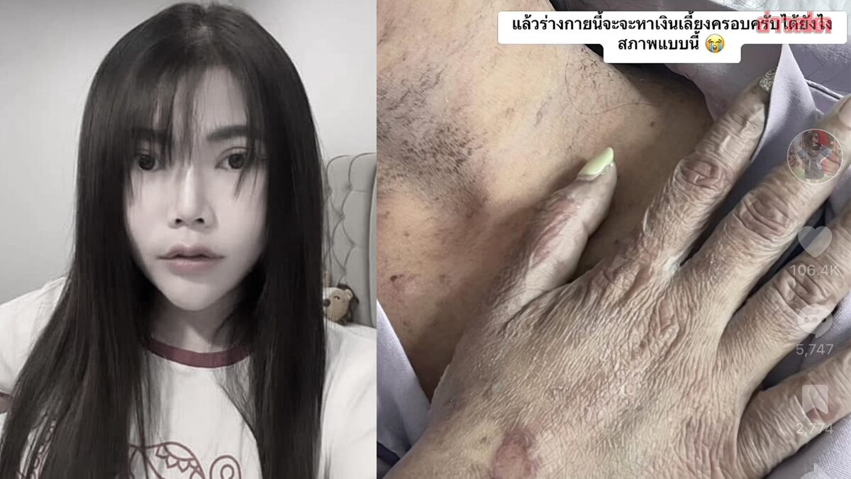 全身流脓一天一夜止不住 泰网红过劳罹罕病身亡