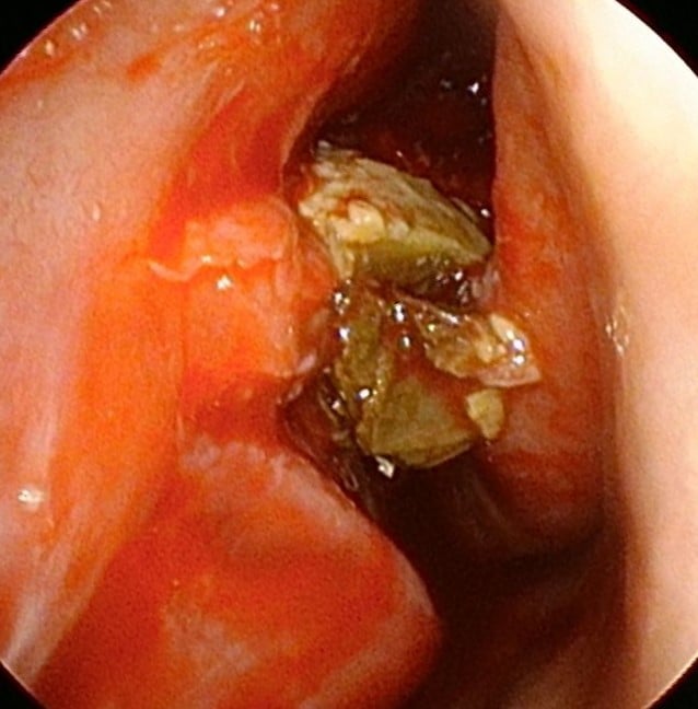 女子一直闻到脚臭味 竟是被发霉老屎块塞爆