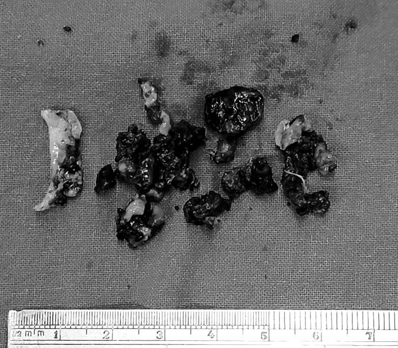 女子一直闻到脚臭味 竟是被发霉老屎块塞爆