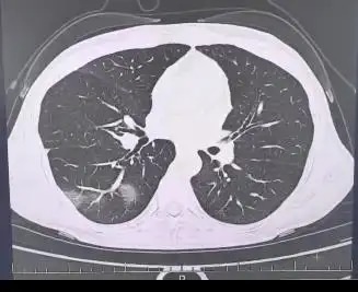 女子高烧3天仍死撑工作 肺部恶化成“白肺”险丧命