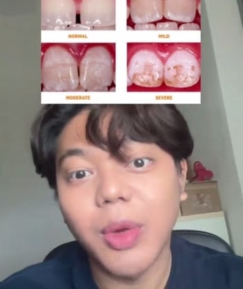 牙膏过量牙齿长白斑块！牙医：豌豆大小使用量就好