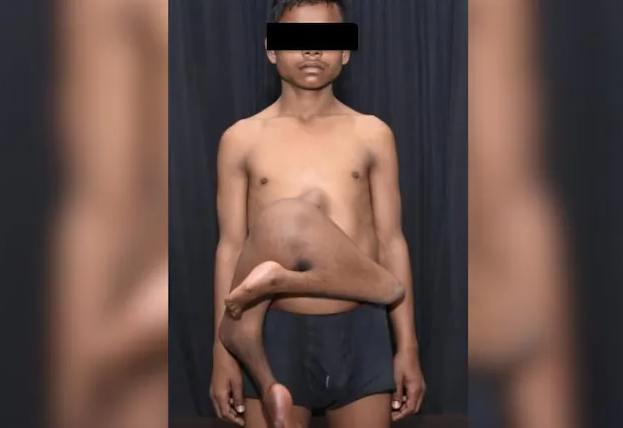 肚子多长一双腿！印度17岁少年“寄生双胞胎”附在胸骨上