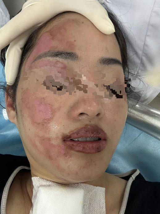 视频|生日会氢气球变火球 寿星女半张脸烧伤