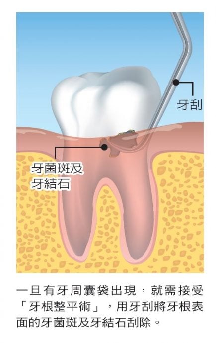 【求真】洗牙会洗掉牙齿保护层？ 牙医：不洗才易蛀牙