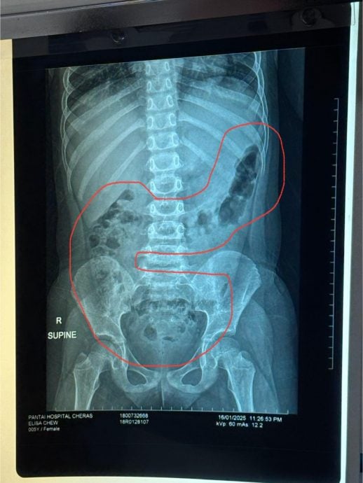 不吃菜的孩子看过来！5岁童频闹腹痛 原来便便塞满肚	