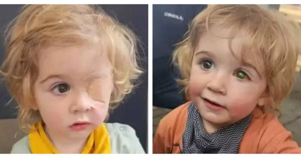 大人一个吻感染疱疹 2岁童左眼穿孔永久失明