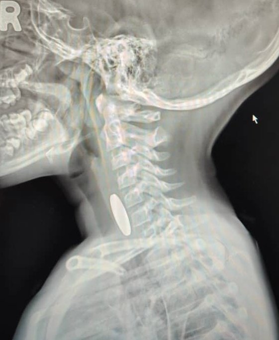 家长看过来！小童误吞游戏币　医生紧急开刀保命